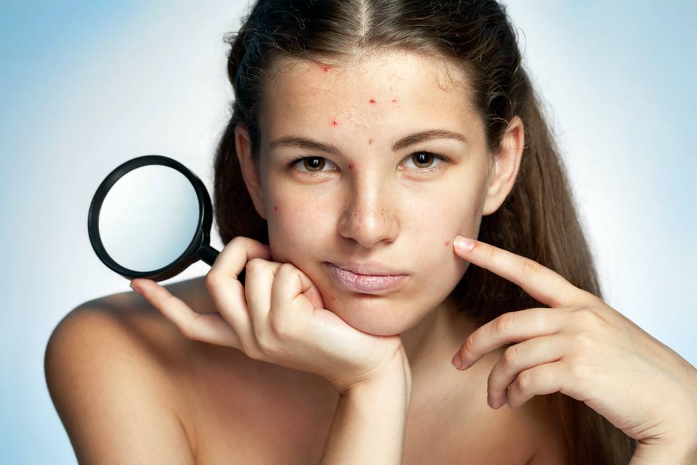 Tot ce trebuie sa stiti despre acnee