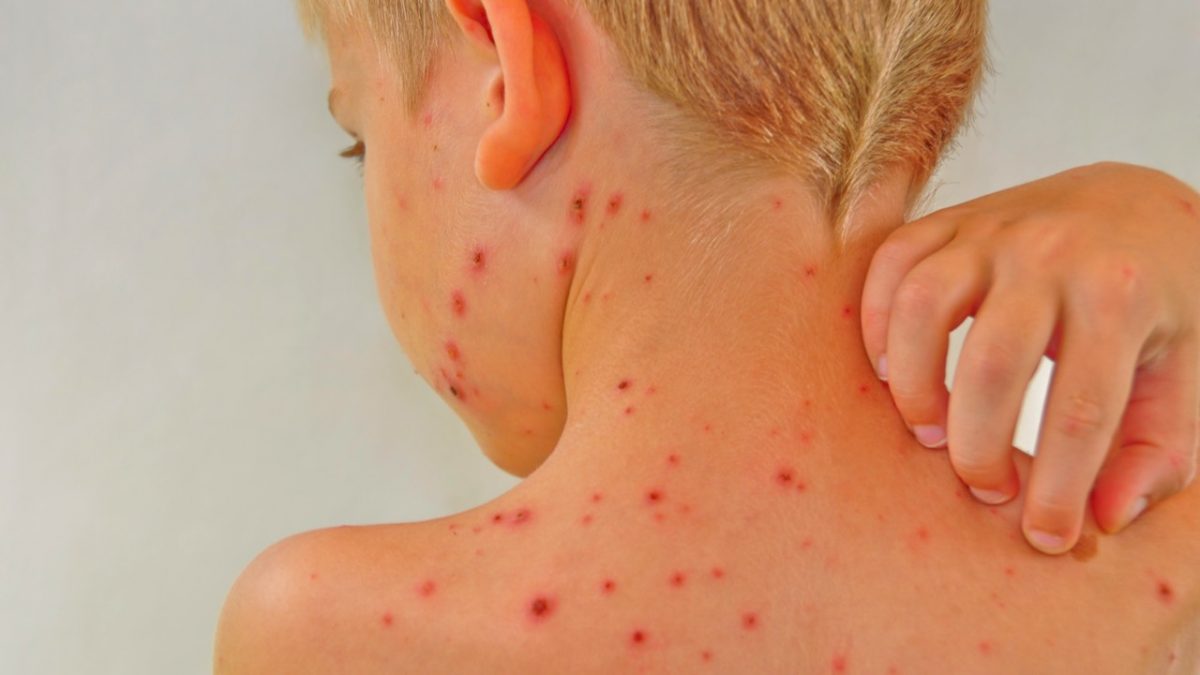 Tot ce trebuie sa stiti despre varicela